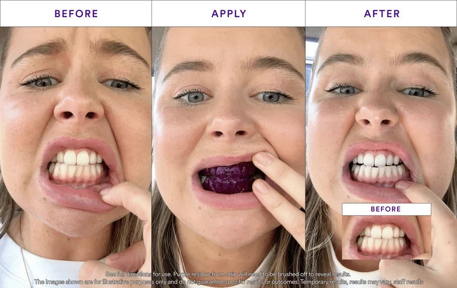 Dambodas™ Purple Teeth Whitening Strips